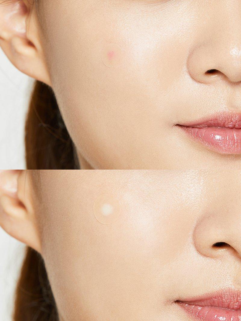 COSRX Acne Pimple Master Patch (24 Patches) - Image 3